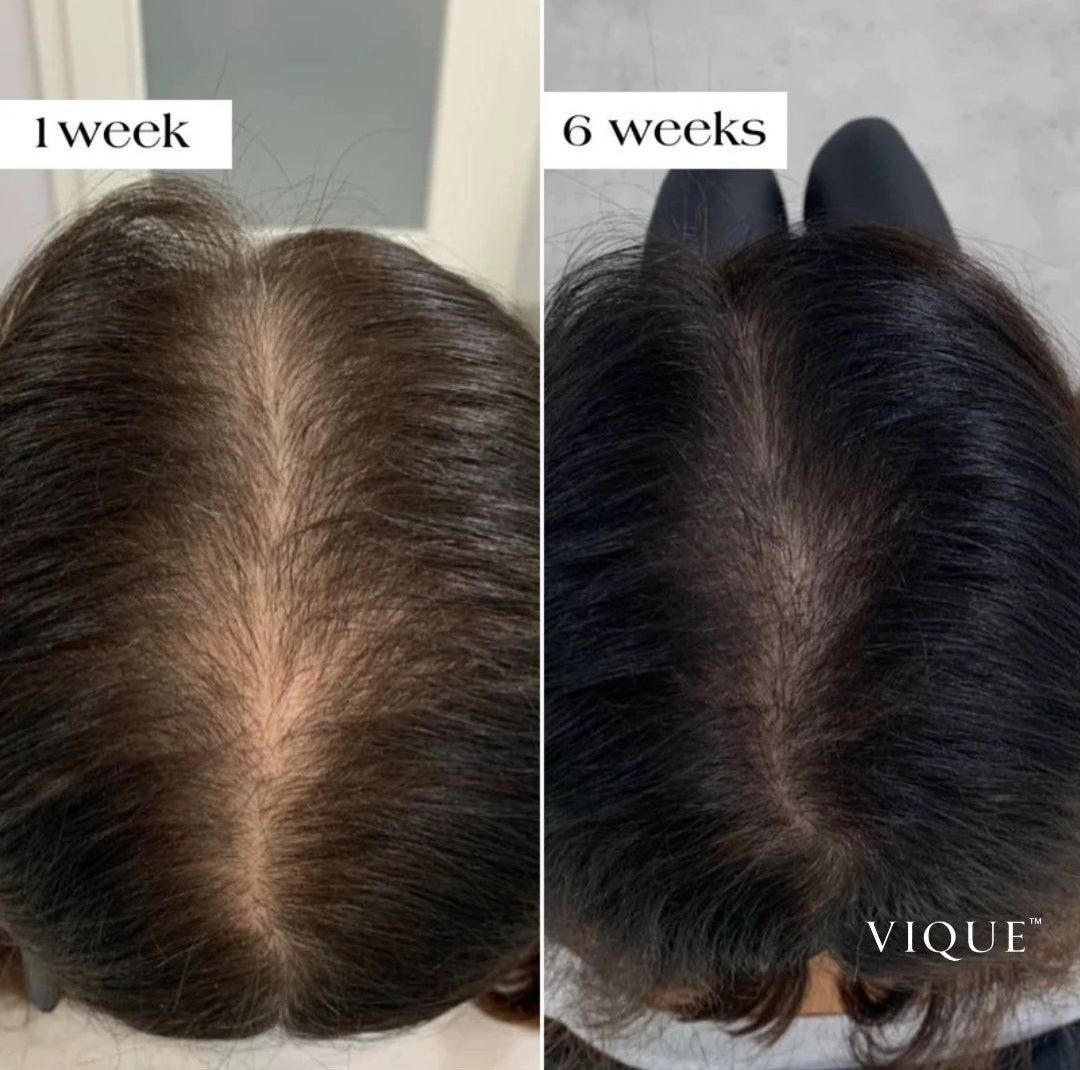 VIQUE™ Microneedle Hair Regrowth Treatment